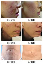 Before and After Skin Needling