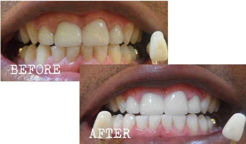 Teeth Whitening